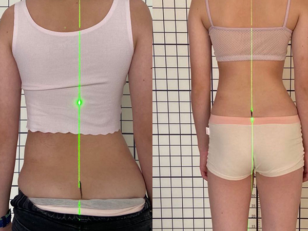 脊柱侧弯的康复治疗